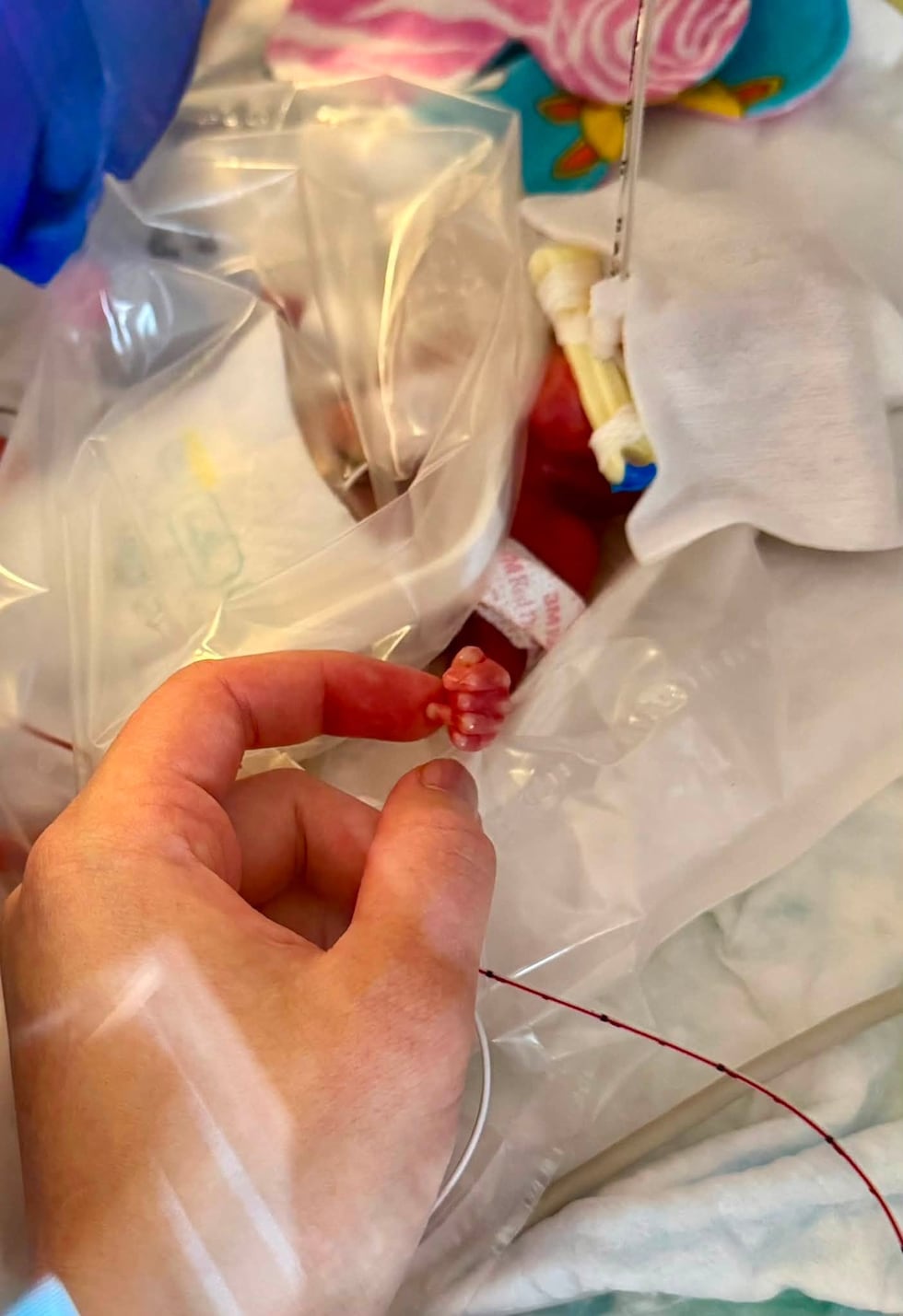 Baby born at 12.5 ounces graduates NICU after 375 days in the hospital
